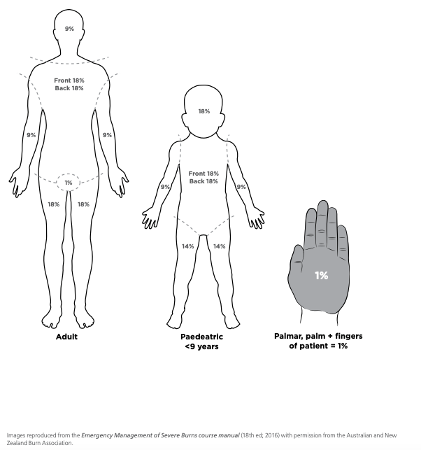 TBSA diagram - 2